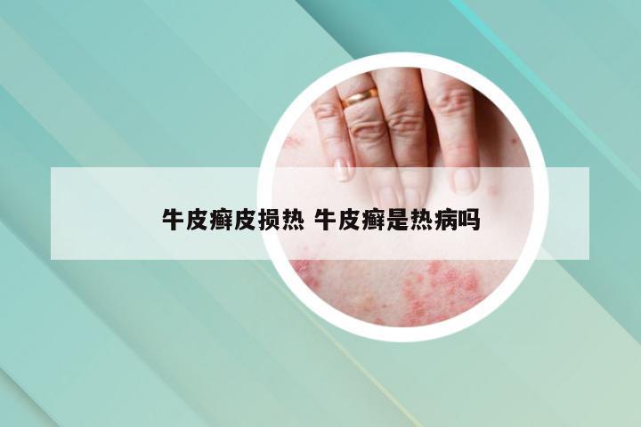 牛皮癣皮损热 牛皮癣是热病吗