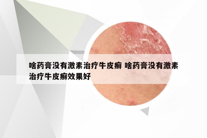 啥药膏没有激素治疗牛皮癣 啥药膏没有激素治疗牛皮癣效果好