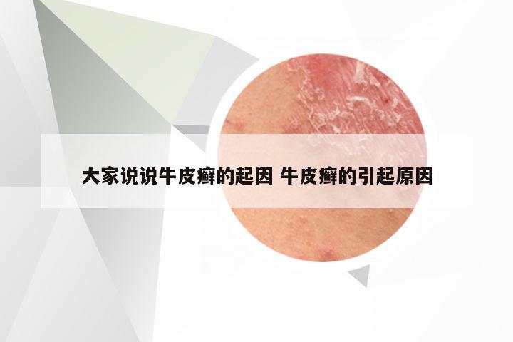 大家说说牛皮癣的起因 牛皮癣的引起原因