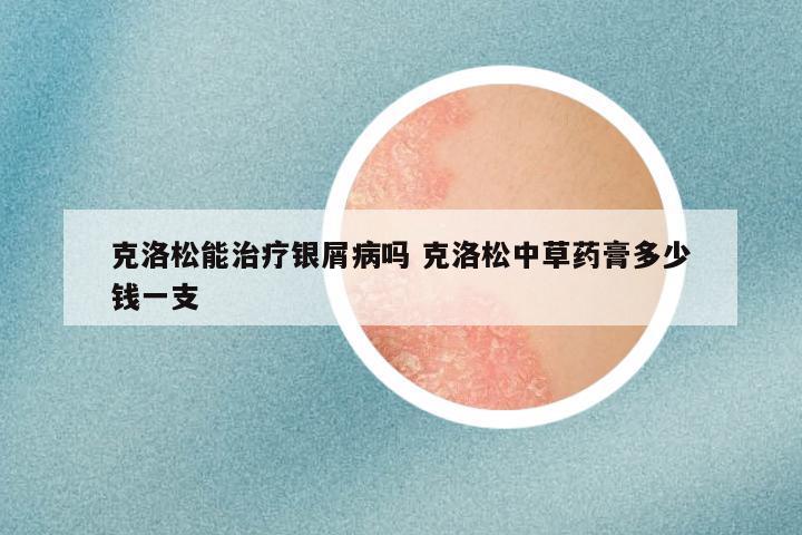 克洛松能治疗银屑病吗 克洛松中草药膏多少钱一支