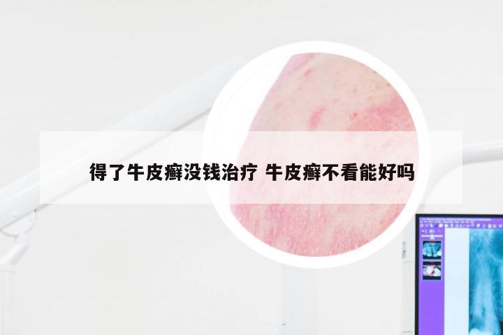 得了牛皮癣没钱治疗 牛皮癣不看能好吗