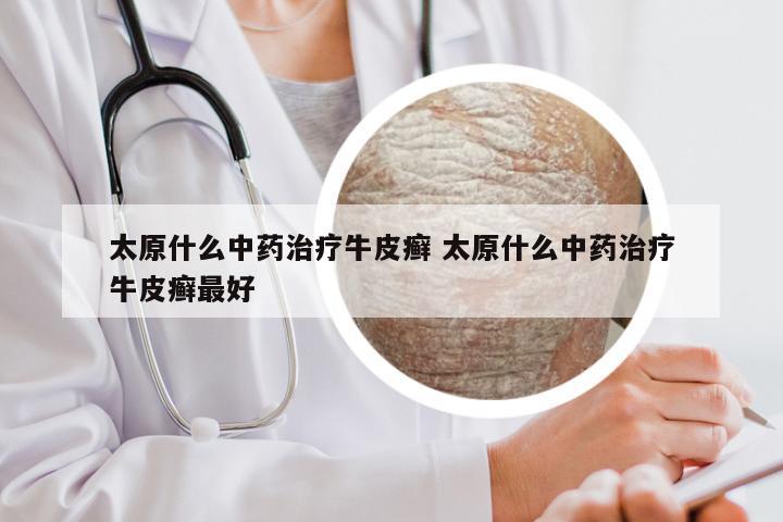 太原什么中药治疗牛皮癣 太原什么中药治疗牛皮癣最好