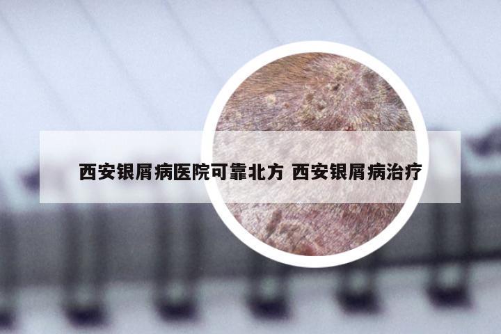 西安银屑病医院可靠北方 西安银屑病治疗