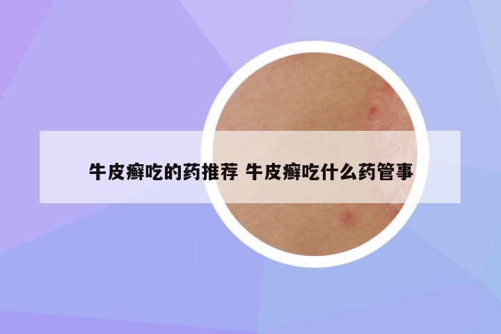 牛皮癣吃的药推荐 牛皮癣吃什么药管事