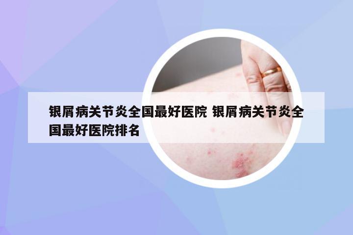 银屑病关节炎全国最好医院 银屑病关节炎全国最好医院排名