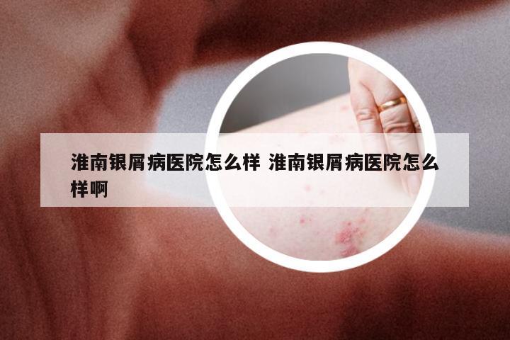 淮南银屑病医院怎么样 淮南银屑病医院怎么样啊