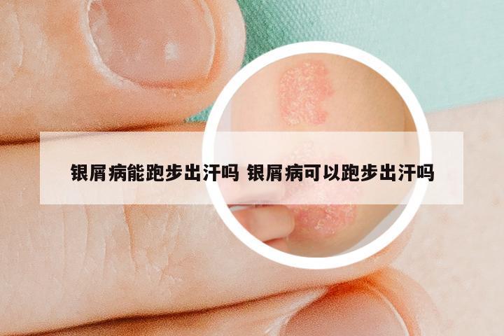 银屑病能跑步出汗吗 银屑病可以跑步出汗吗