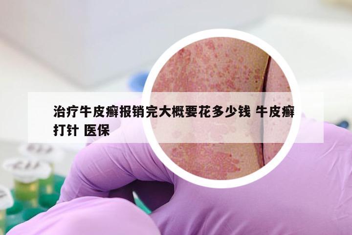 治疗牛皮癣报销完大概要花多少钱 牛皮癣 打针 医保