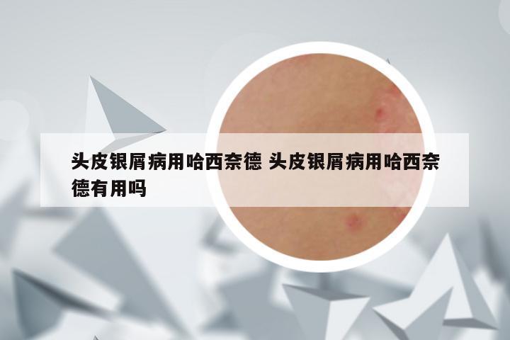 头皮银屑病用哈西奈德 头皮银屑病用哈西奈德有用吗