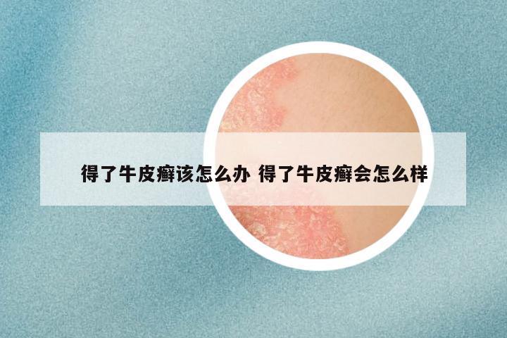得了牛皮癣该怎么办 得了牛皮癣会怎么样