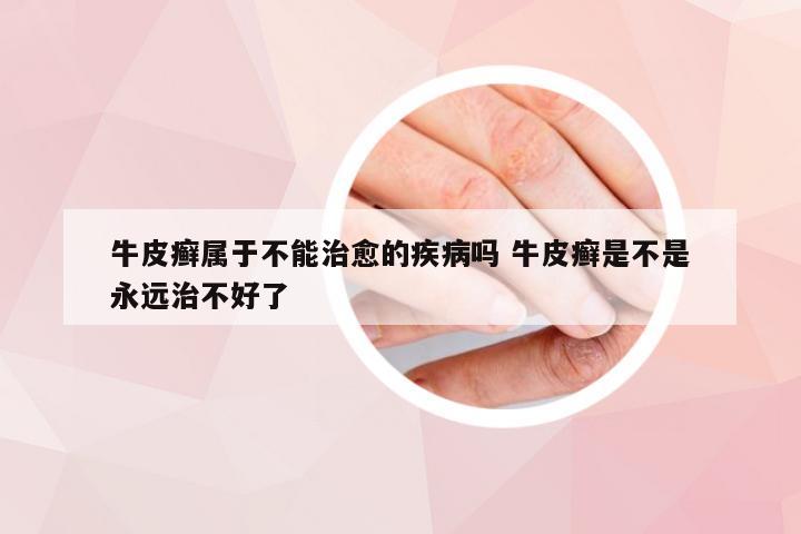 牛皮癣属于不能治愈的疾病吗 牛皮癣是不是永远治不好了