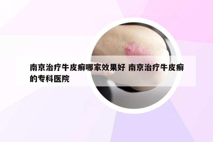 南京治疗牛皮癣哪家效果好 南京治疗牛皮癣的专科医院