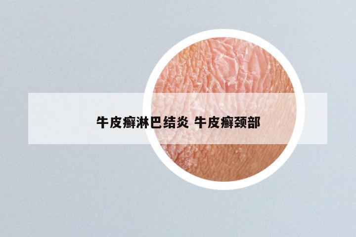 牛皮癣淋巴结炎 牛皮癣颈部