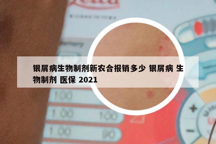 银屑病生物制剂新农合报销多少 银屑病 生物制剂 医保 2021