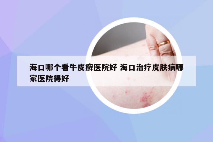 海口哪个看牛皮癣医院好 海口治疗皮肤病哪家医院得好