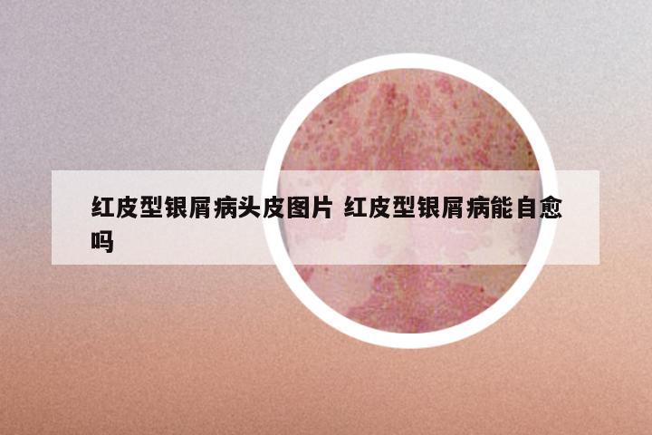 红皮型银屑病头皮图片 红皮型银屑病能自愈吗