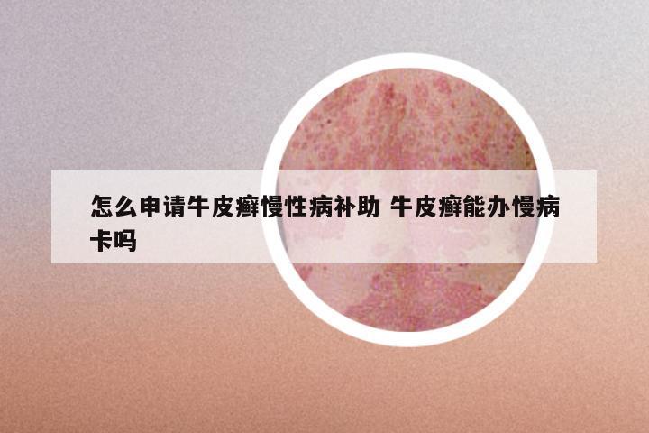 怎么申请牛皮癣慢性病补助 牛皮癣能办慢病卡吗