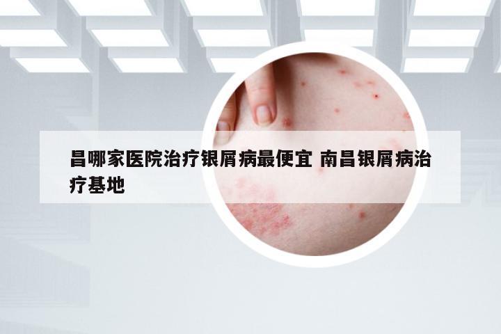 昌哪家医院治疗银屑病最便宜 南昌银屑病治疗基地