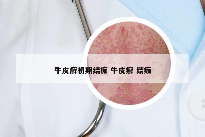 牛皮癣初期结痂 牛皮癣 结痂