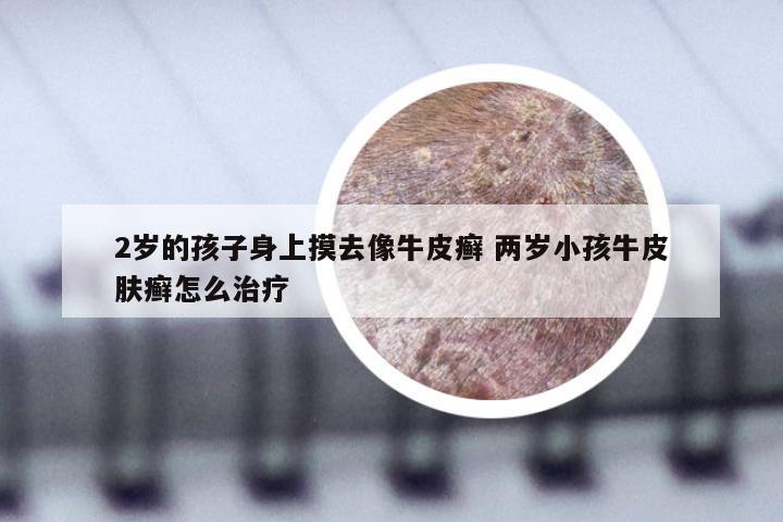2岁的孩子身上摸去像牛皮癣 两岁小孩牛皮肤癣怎么治疗