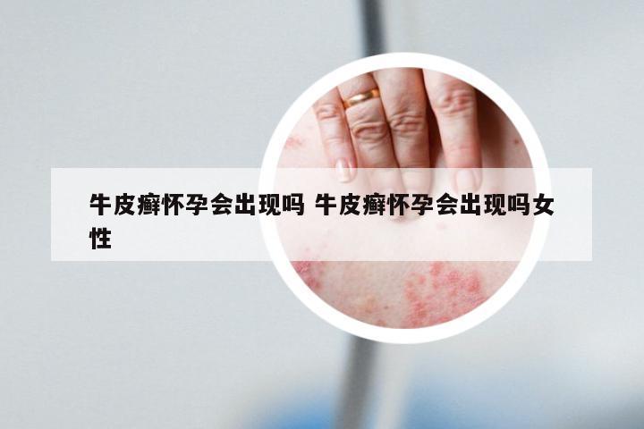 牛皮癣怀孕会出现吗 牛皮癣怀孕会出现吗女性