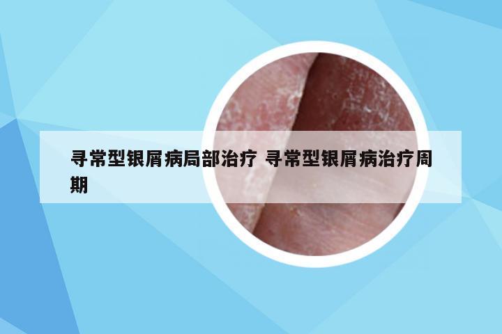 寻常型银屑病局部治疗 寻常型银屑病治疗周期
