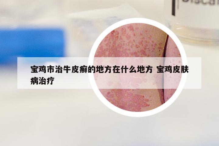宝鸡市治牛皮癣的地方在什么地方 宝鸡皮肤病治疗