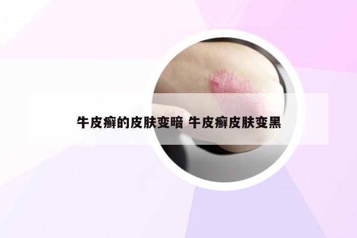 牛皮癣的皮肤变暗 牛皮癣皮肤变黑