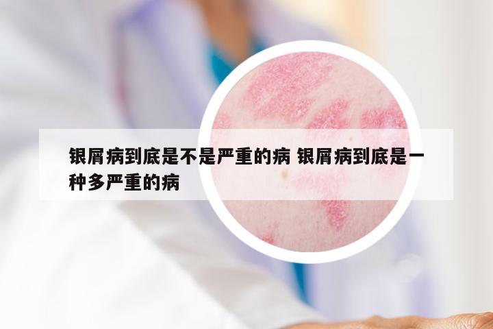 银屑病到底是不是严重的病 银屑病到底是一种多严重的病