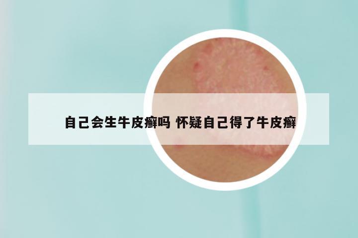 自己会生牛皮癣吗 怀疑自己得了牛皮癣