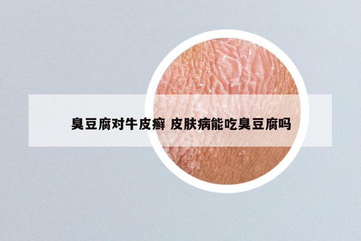 臭豆腐对牛皮癣 皮肤病能吃臭豆腐吗