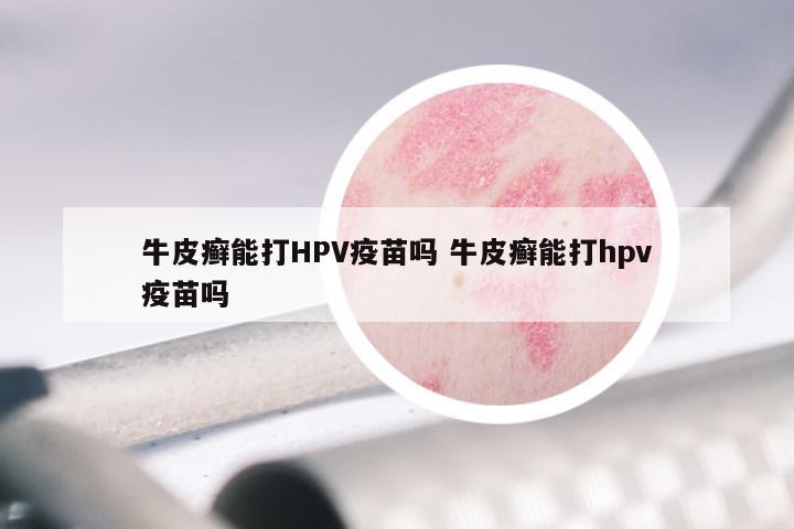 牛皮癣能打HPV疫苗吗 牛皮癣能打hpv疫苗吗