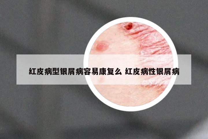 红皮病型银屑病容易康复么 红皮病性银屑病