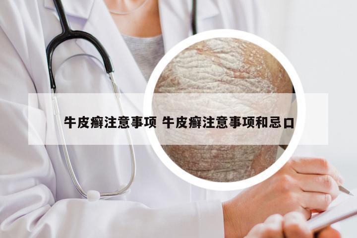 牛皮癣注意事项 牛皮癣注意事项和忌口