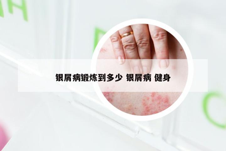 银屑病锻炼到多少 银屑病 健身