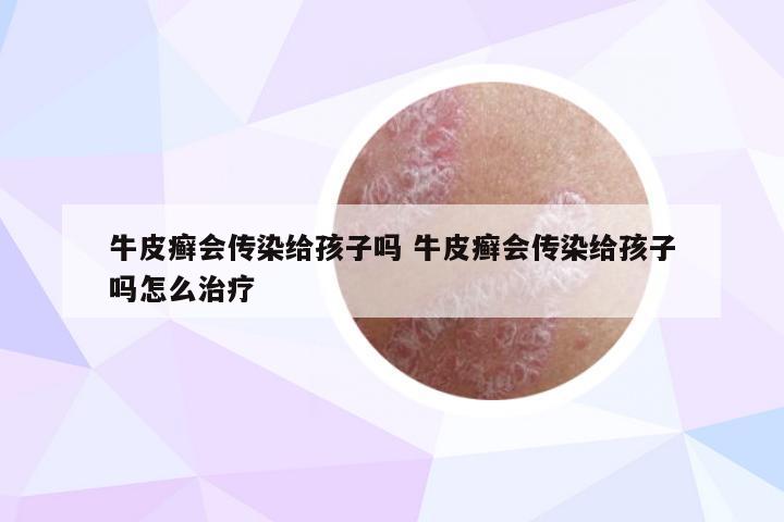 牛皮癣会传染给孩子吗 牛皮癣会传染给孩子吗怎么治疗