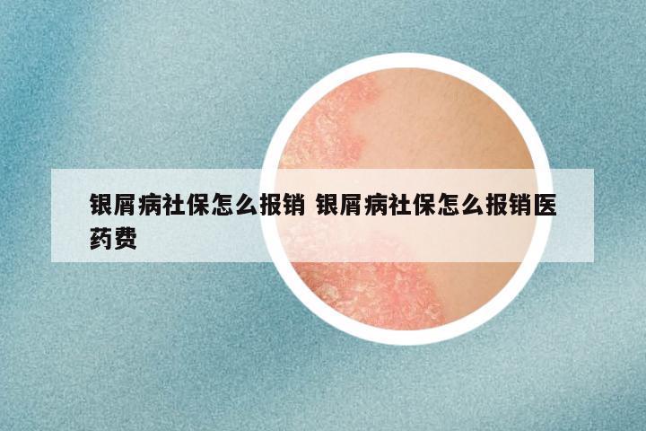 银屑病社保怎么报销 银屑病社保怎么报销医药费