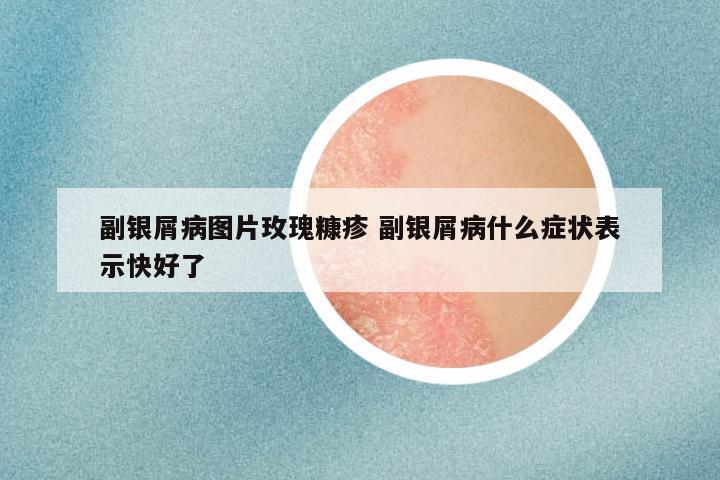 副银屑病图片玫瑰糠疹 副银屑病什么症状表示快好了