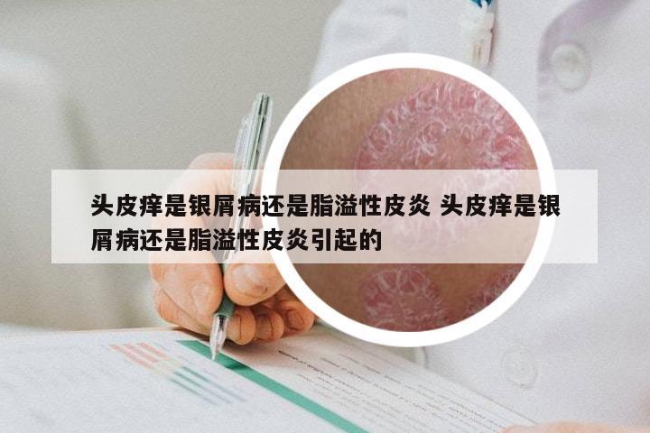 头皮痒是银屑病还是脂溢性皮炎 头皮痒是银屑病还是脂溢性皮炎引起的