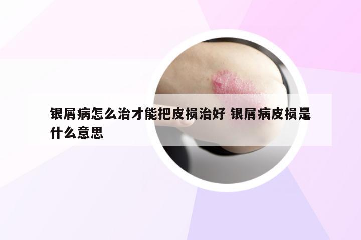 银屑病怎么治才能把皮损治好 银屑病皮损是什么意思