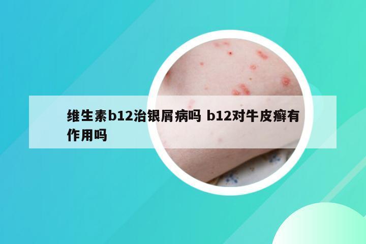 维生素b12治银屑病吗 b12对牛皮癣有作用吗