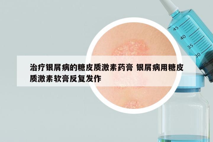 治疗银屑病的糖皮质激素药膏 银屑病用糖皮质激素软膏反复发作