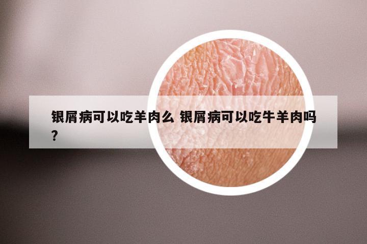 银屑病可以吃羊肉么 银屑病可以吃牛羊肉吗?