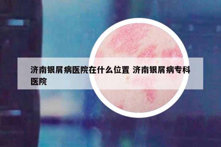 济南银屑病医院在什么位置 济南银屑病专科医院