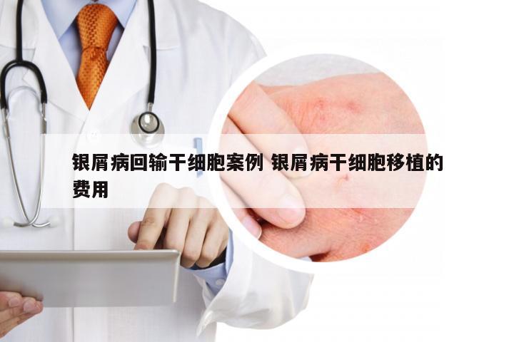 银屑病回输干细胞案例 银屑病干细胞移植的费用