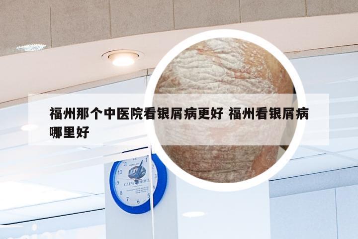 福州那个中医院看银屑病更好 福州看银屑病哪里好