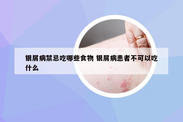 银屑病禁忌吃哪些食物 银屑病患者不可以吃什么