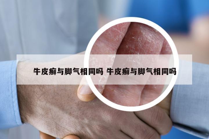 牛皮癣与脚气相同吗 牛皮癣与脚气相同吗