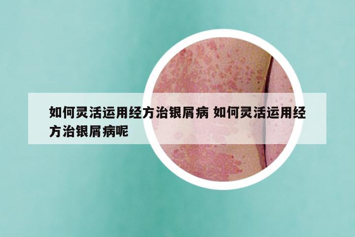 如何灵活运用经方治银屑病 如何灵活运用经方治银屑病呢