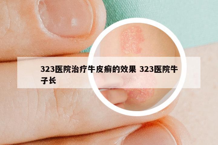 323医院治疗牛皮癣的效果 323医院牛子长